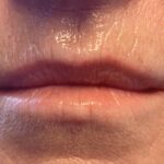 Lip Injections Before & After Patient #806