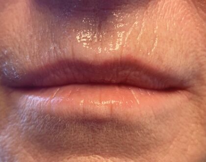 Lip Injections Before & After Patient #806