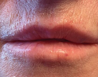 Lip Injections Before & After Patient #806