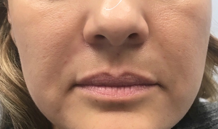 Laugh Lines Before & After Patient #811