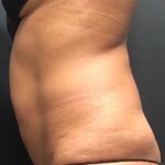 CoolSculpting Before & After Patient #669