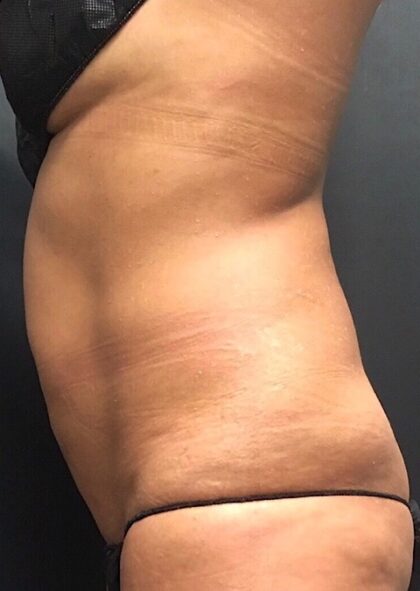 CoolSculpting Before & After Patient #669