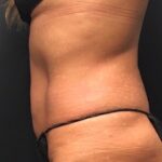 CoolSculpting Before & After Patient #669