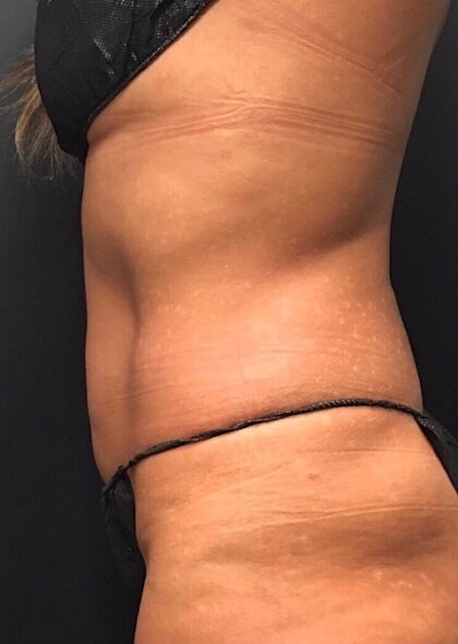 CoolSculpting Before & After Patient #669