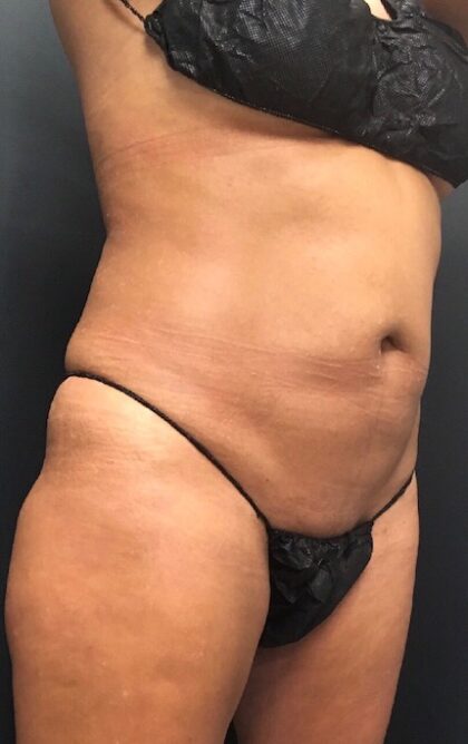 CoolSculpting Before & After Patient #669