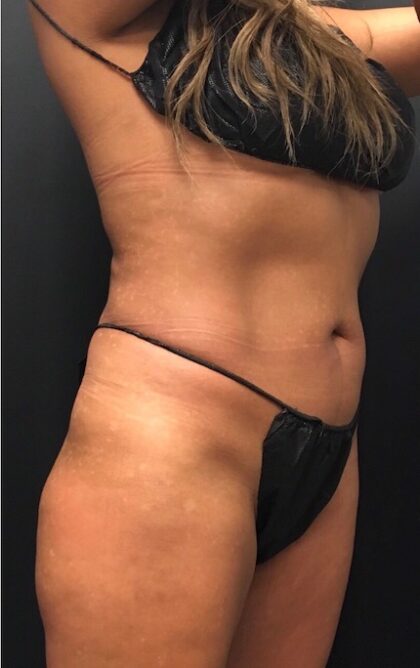 CoolSculpting Before & After Patient #669