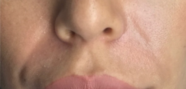 Laugh Lines Before & After Patient #820