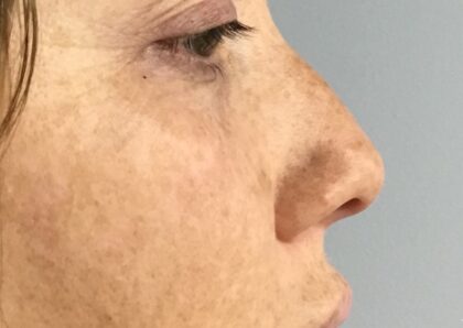 Non-Surgical Nose Job Before & After Patient #826