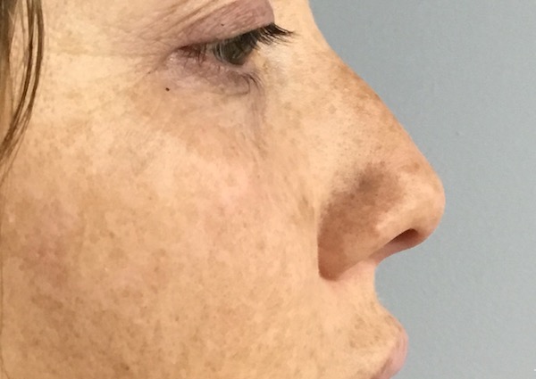 Non-Surgical Nose Job Before & After Patient #826