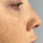 Non-Surgical Nose Job Before & After Patient #826