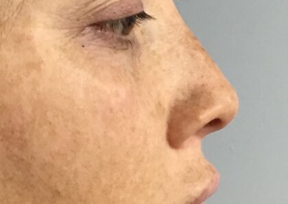 Non-Surgical Nose Job Before & After Patient #826