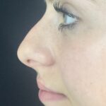 Non-Surgical Nose Job Before & After Patient #829