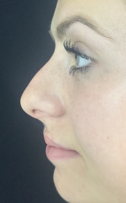 Non-Surgical Nose Job Before & After Patient #829