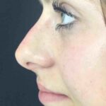 Non-Surgical Nose Job Before & After Patient #829
