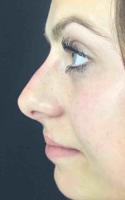 Non-Surgical Nose Job Before & After Patient #829