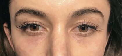 Under Eye Circles Before & After Patient #832