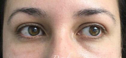 Under Eye Circles Before & After Patient #835