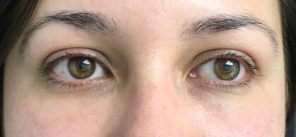 Under Eye Circles Before & After Patient #835