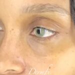 Under Eye Circles Before & After Patient #838