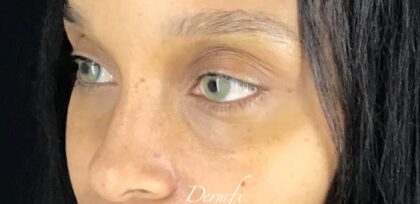 Under Eye Circles Before & After Patient #838
