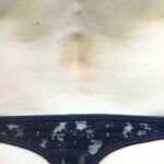 CoolSculpting Before & After Patient #407