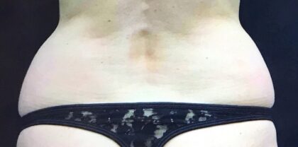 CoolSculpting Before & After Patient #407