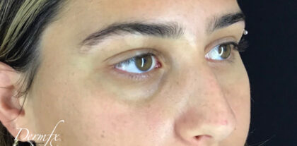Under Eye Circles Before & After Patient #841