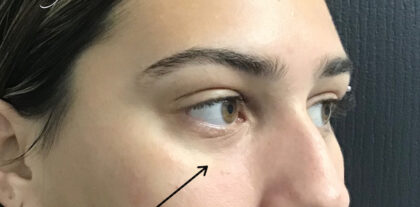 Under Eye Circles Before & After Patient #841