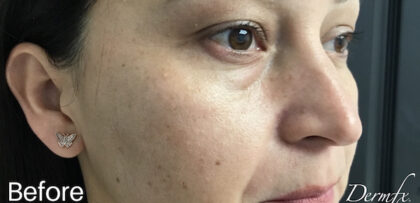 Under Eye Circles Before & After Patient #845