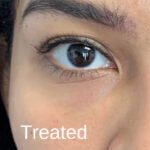 Under Eye Circles Before & After Patient #848