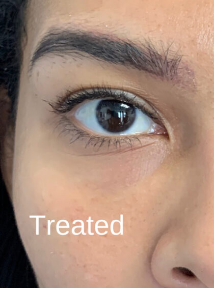 Under Eye Circles Before & After Patient #848