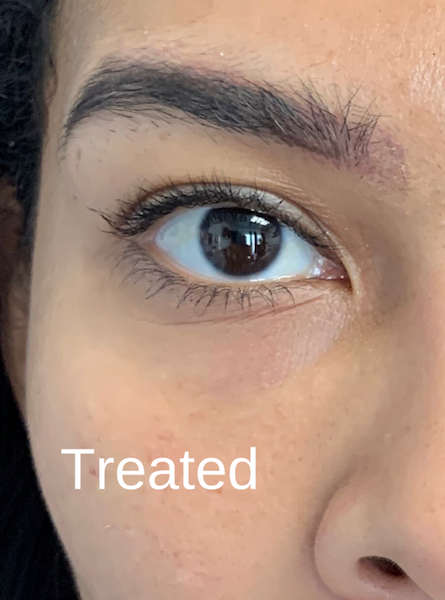 Under Eye Circles Before & After Patient #848
