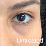 Under Eye Circles Before & After Patient #848
