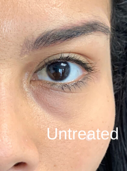 eyes dark circles before after