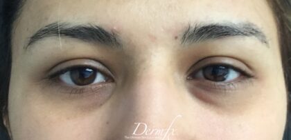 Under Eye Circles Before & After Patient #853