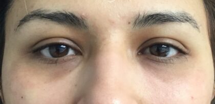Under Eye Circles Before & After Patient #853