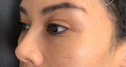 Under Eye Circles Before & After Patient #848