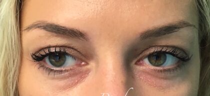 Under Eye Circles Before & After Patient #859