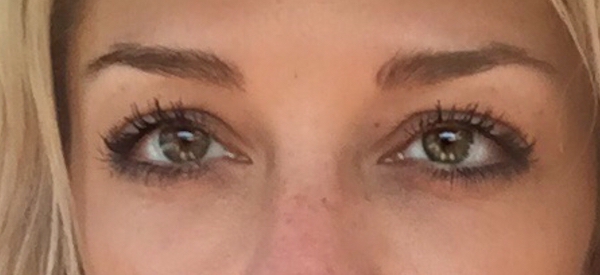 Under Eye Circles Before & After Patient #859