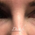 Under Eye Circles Before & After Patient #860