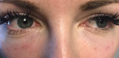 Under Eye Circles Before & After Patient #860