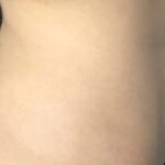 CoolSculpting Before & After Patient #677