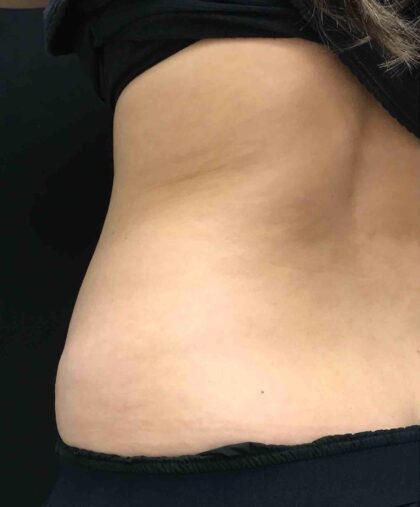 CoolSculpting Before & After Patient #680