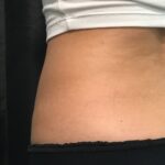 CoolSculpting Before & After Patient #680
