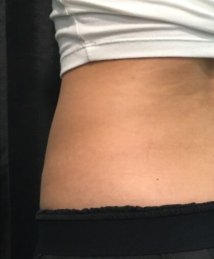 CoolSculpting Before & After Patient #680