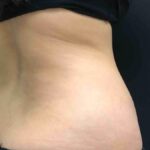 CoolSculpting Before & After Patient #680