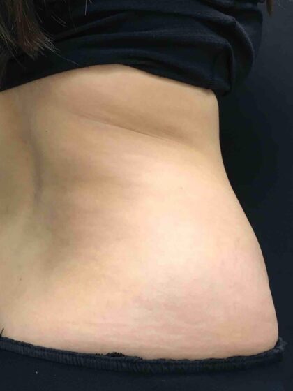 CoolSculpting Before & After Patient #680