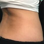 CoolSculpting Before & After Patient #680