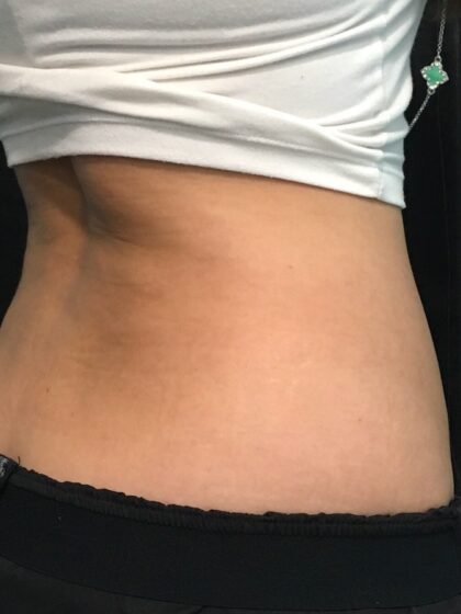 CoolSculpting Before & After Patient #680