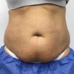 CoolSculpting Before & After Patient #686